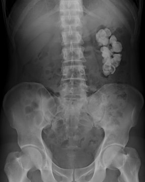 X-ray image of urinary system (kidney urinary and bladder: KUB), show renal and ureteral calculous obstruction at left side