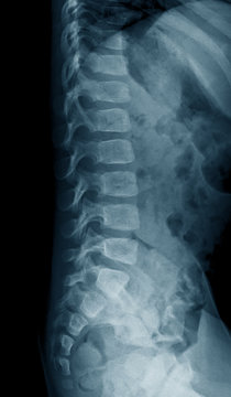 Lumbosacral spine (LS spine) x-ray, lateral view, a 2 year old asian boy patient