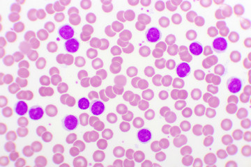 Blood picture of chronic lymphocytic leukemia or CLL, analyze by microscope, original magnification...