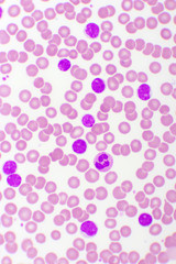 Blood picture of chronic lymphocytic leukemia or CLL, analyze by microscope, original magnification 400x