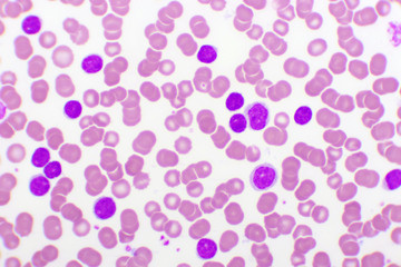 Blood picture of chronic lymphocytic leukemia or CLL, analyze by microscope, original magnification 400x