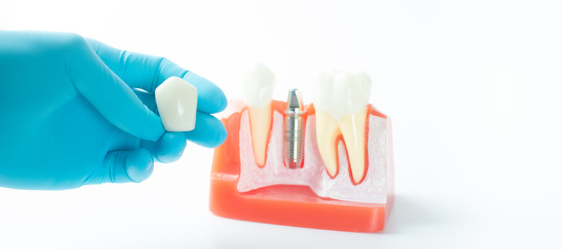 Dental implant model on white background.