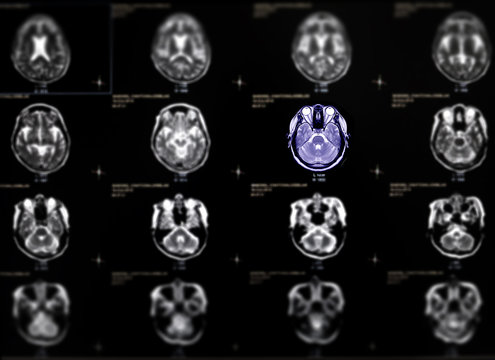 Selective focus of MRI brain axial view for detect a variety of conditions of the brain such as cysts, tumors, bleeding, swelling, developmental and structural abnormalities or infections .