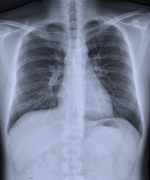 Film x-ray chest PA upright with normal lungs.