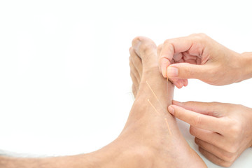 Closeup of hand performing acupuncture therapy young Asian man's plantar