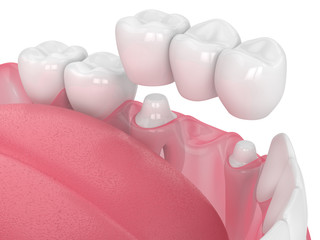 3d render of jaw with dental bridge