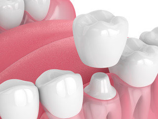 3d render of jaw with teeth and dental crown restoration