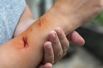 The wound form scabs on hand and arm. The wound happen during woman Injuries from falling down on road.