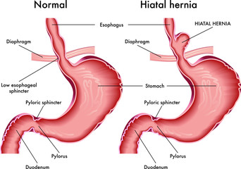 Medical illustration of stomach with hiatal hernia with annotation.