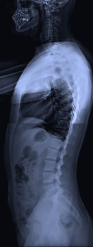 X-ray of whole spine Lateral position in dark background.