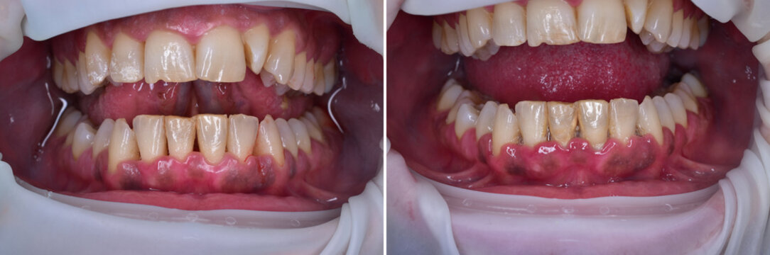 Treatment Of Gum Disease By Deep Cleaning