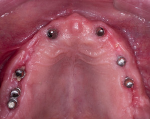 Fototapeta premium full mought re construction by dental implants and ceramic crowns