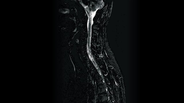Volumetric MRI of the cervical spine, detection of protrusions and hernias