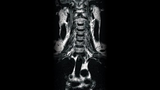 Volumetric MRI of the cervical spine, detection of protrusions and hernias