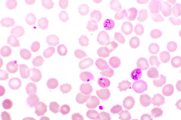 Malaria parasite in red blood cells, ring form stage of Plasmodium falciparum, original magnification 1000x
