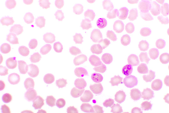 Malaria parasite in red blood cells, ring form stage of Plasmodium falciparum, original magnification 1000x