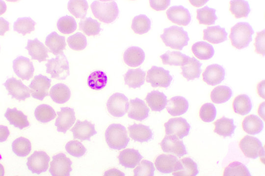 Malaria parasite in red blood cells, ring form stage of Plasmodium falciparum, original magnification 1000x
