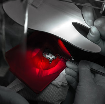 tdentistry. dental treatment, close-up. teeth and caries.
