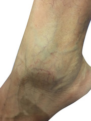 Varicose veins Ankle joint of Lady with background White.