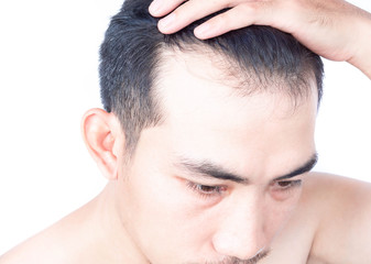 Obraz premium Young man serious hair loss problem for health care medical and shampoo product concept, selective focus