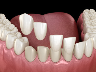 Veneer installation procedure over central incisor and lateral incisors. Medically accurate tooth 3D illustration