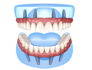 Maxillary and Mandibular prosthesis with gum All on 4 system supported by implants. Medically accurate 3D illustration of human teeth and dentures