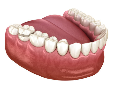 Onlay ceramic crown fixation over molar tooth. Medically accurate 3D illustration of human teeth treatment