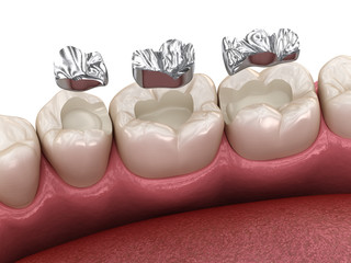 Amalgam restoration. Medically accurate 3D animation of dental concept