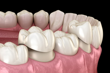 Fototapeta na wymiar Porcelain crowns placement over premolar and molar teeth. . Medically accurate 3D illustration
