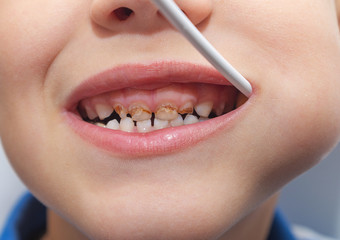 Child with bad, unhealthy teeth eating a lollipop. Decay of deciduous teeth. The symbolic image of the harm of sugar, sweets and sweet food, dental problems. Close-up, selective focus.