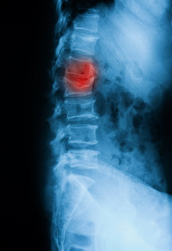 Thoracolumbar spine (T-L spine) X-ray, lateral view, showing spinal compression fracture or vertebral bursh fracture  at L4 (4th Lumbar Vertebra)