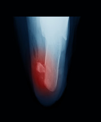X-ray image of  Axial calcaneus (heel) showing achilles tendon rupture and heel fracture