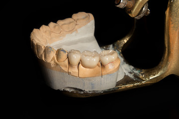 Dental veneers, ceramic and zirconium crowns of teeth close-up macro isolate on black background. Laboratory technical production of prostheses