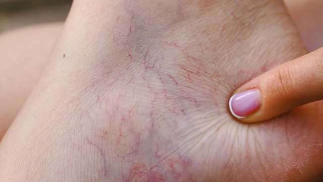 Vascular dilatation of veins on leg
