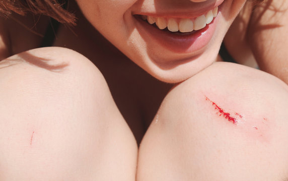 Close up view of young woman  smiling with bruised knee