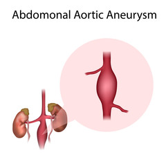 Abdominal aortic aneurysm. Widening of the vessel. Medical illustration.