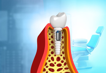 Dental implant concept on medical background. 3d illustration.