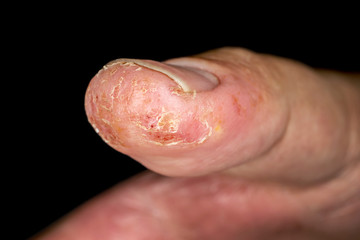 Closeup of eczema dermatitis allergic skin rash on male thumb with skin peeling. . Isolated over black background. Macro. Shallow depth of field.