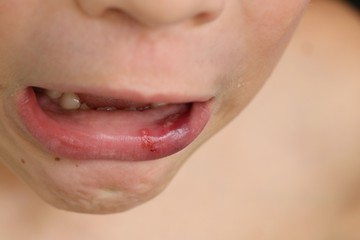 The lip bleeding and crying boy from the bumping accident. Bad babysitting. Child injury