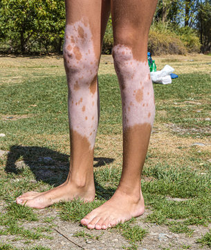 Legs Of A Girl With Vitiligo