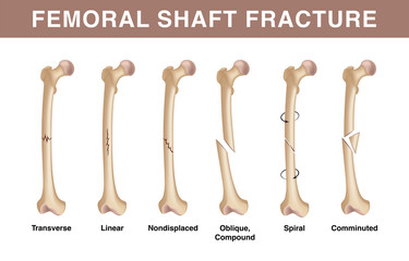 Types of femoral shuft fractures. Realistic drawing showing broken bone with inscriptions isolated on whie background. - obrazy, fototapety, plakaty