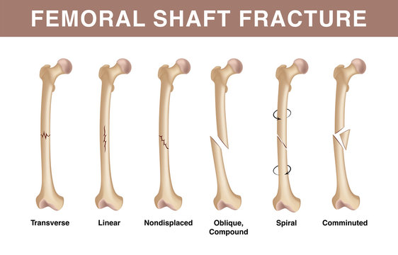 Types of femoral shuft fractures. Realistic drawing showing broken bone with inscriptions isolated on whie background.