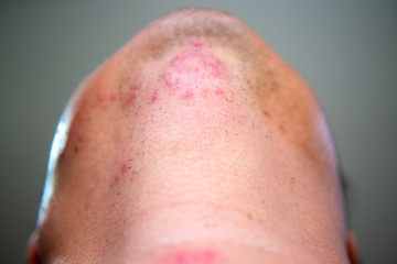 Young men who are sick are herpes zoster at the face and throat