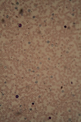 Malariaparasiten in roten Blutkörperchen  unter dem Mikroskop 400x