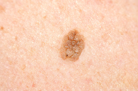 papillomas on the skin
