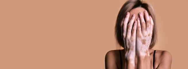 Girl with vitiligo disease covers her face with hands, closeup portrait on beige background