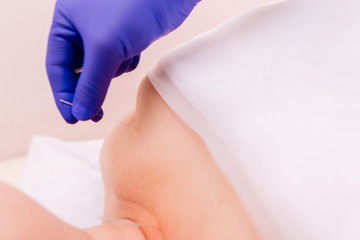 Fototapeta premium Therapist performing acupuncture therapy on woman's body. Traditional Chinese treatment, alternative medicine
