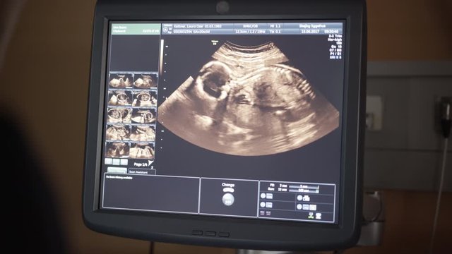 Shot of an Ultrasound Monitor and an Active Baby During a Sonography Scan