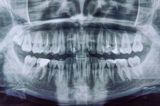 Panoramic x-ray scanning of human teeth. Women's the teeth with one tooth of wisdom