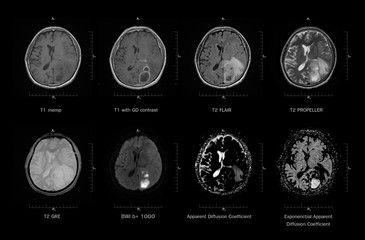Magnetic resonance imaging (MRI-scan) of brain disease (Stroke), Axial view, 